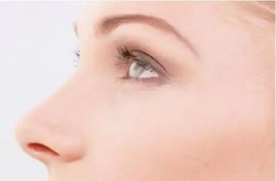 玻尿酸隆鼻是一种比较方便快速的隆鼻