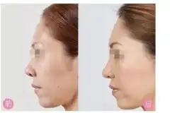 深圳做隆鼻手术多少钱隆鼻前后对比图隆鼻医院哪里好第148页深圳美莱整形美容医院