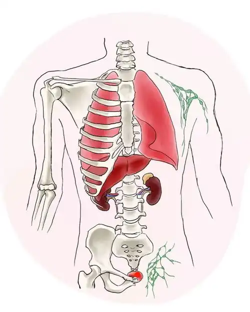 手绘美图低负荷转移性前列腺癌