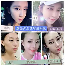 面填变治愈系少女郑州自体脂肪填充全脸私信有红包治愈系美少女18岁是少女80岁是资深少女悦美整形