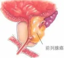 四类人群需警惕前列腺癌