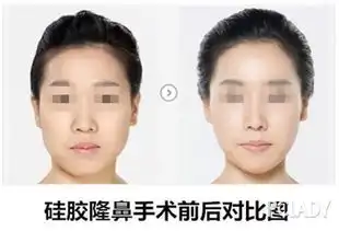 硅胶隆鼻的材料隆鼻手术安全吗硅胶隆鼻能维持多久