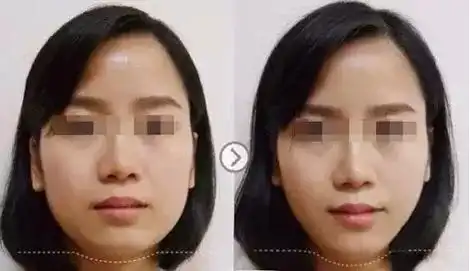 瘦脸针别轻易打后果太惊人了