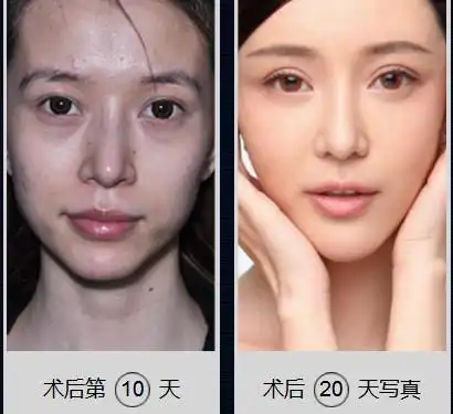 玻尿酸隆鼻下巴真人案例过程解析,想变美的速速点进来.....