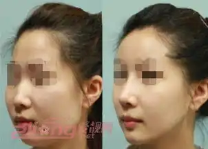 玻尿酸隆鼻价格,玻尿酸隆鼻对比照