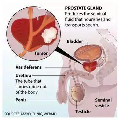 结合基因组测序的前列腺癌精准治疗