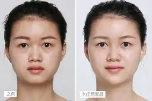 下巴填充玻尿酸图片