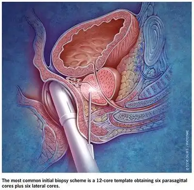 nejm前列腺癌联合活检可显著提高诊断准确度