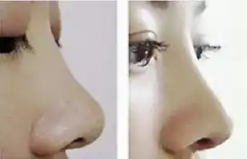 做玻尿酸隆鼻术立马拥有自然完美鼻形