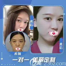 石家庄蓝山全城招募101名美丽代言活动正在进行中还有包含双眼皮多项整形项目低至3.8折