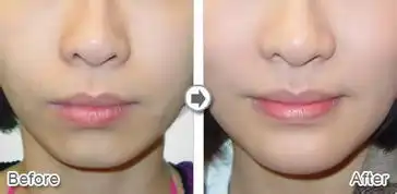 玻尿酸隆下巴