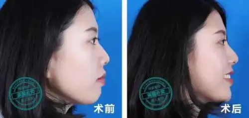 玻尿酸注射技术交流会暨乔雅登背后的科学在潍医整形隆重举行