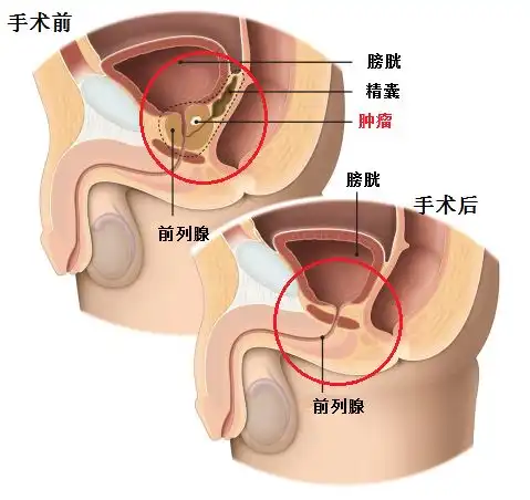 局限性前列腺癌治疗根治手术是首选