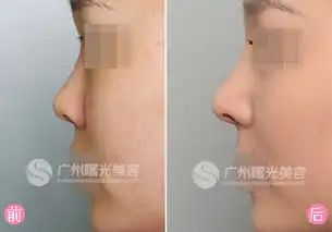 玻尿酸注射隆鼻优点有哪些