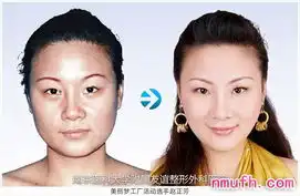 自体脂肪除皱怎么预防失败