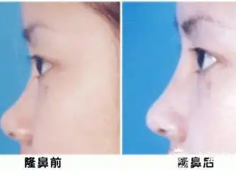 美贝尔注射隆鼻秀出新高度