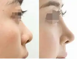 郑州医生为你讲述瑞蓝玻尿酸隆鼻的优势