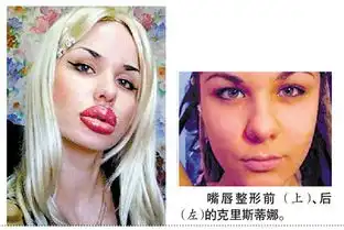 俄少女注射100次硅胶整出最丰满香肠嘴